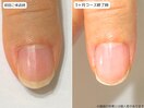 自爪育成・深爪・川崎