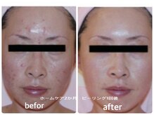 エミー(emy)/江坂/毛穴/ハーブピーリング