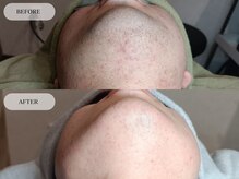 メンズプラス(MEN’S PLUS)/ヒゲ脱毛/ビフォーアフター写真