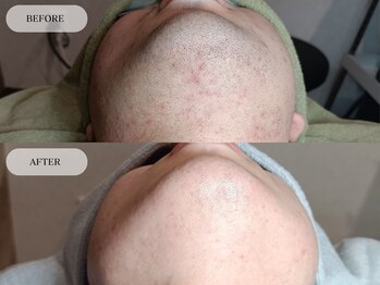 メンズプラス(MEN’S PLUS)/ヒゲ脱毛/ビフォーアフター写真