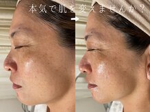 サロンドシエル カスガイ(Salon de Ciel kasugai)/ボンバーフェイシャル