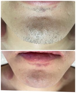 シャイニースキン(Shiny skin)/ヒゲ脱毛