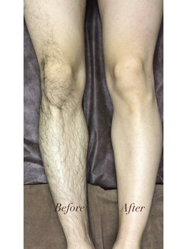 ラヴィアンクレール 梅田店(La vie en Clair)/◆脚ワックス脱毛◆