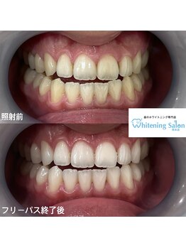 ホワイトニングサロン 熊本店/熊本セルフホワイトニング