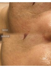 アエ(ae)/ダクトピール