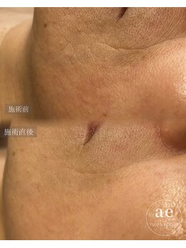 アエ(ae)/ダクトピール