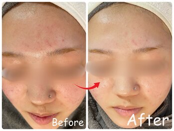 エレ(ele)/【施術後1ヶ月】剥けるハーブ◎