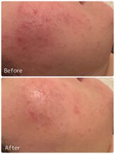 ククル(KUKULU)/陶肌トリートメント7回目♪(20代