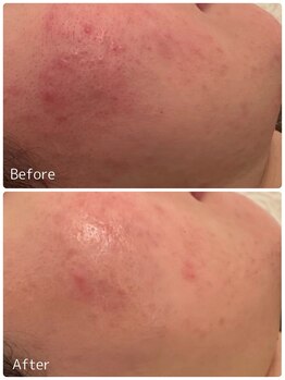 ククル(KUKULU)/陶肌トリートメント7回目♪(20代