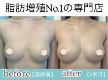 サラエクセレント 銀座/ふっくらおわん型に♪バストケア