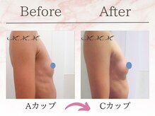 エムエムエム 表参道Luxeサロン(M.M.M)/【バストアップ例】　A→Cカップ