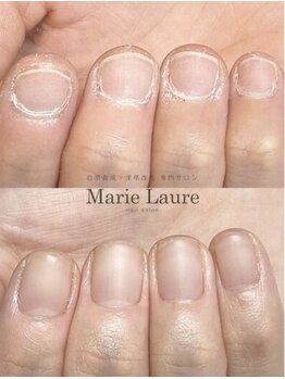 マリーロール 天王寺店(Marie Laure)/自爪育成/深爪矯正/ネイルケア