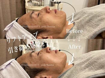エステティックス ナインワンワン 横浜(Esthetics911) /メンズスキンケア！リフトアップ