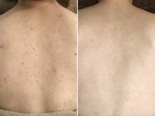 ハダイ(HADAY)/ニキビ改善｜ハーブピーリング