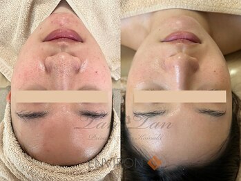 プライベートサロン タンタン(tantan)/毛穴/ニキビ 20代女性