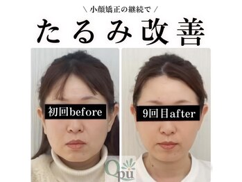 キュープ 高崎店(Qpu)/小顔頭蓋骨矯正＋リンパケア