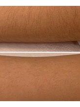 キト(KITO)/ジュニア脱毛