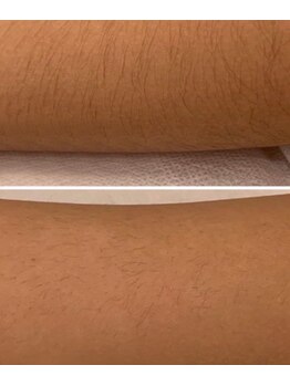 キト(KITO)/ジュニア脱毛