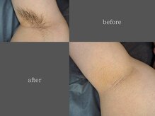 テリー(Terry)/men's脱毛before after 5回照射