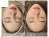 67%OFF【先着5名】お顔:剥けるハーブピーリング&鎮静ケア