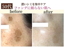 パールホワイトニング/大きいシミ/老半改善で劇的変化