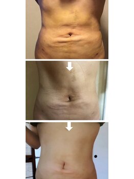 スリーピングビューティー(Sleeping Beauty)/インディバ　術後ケア