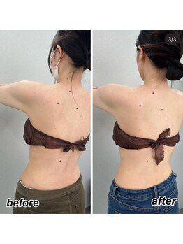 ヴィーナス(Venus)/ブライダル痩身　3回