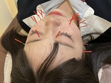 鶴見わだち整骨院/美容鍼でニキビケアも