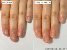 自爪育成・深爪・川崎