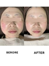 ゼロ(ZERO)/シミシワ肌質改善スペシャル