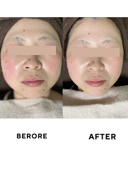 ゼロ(ZERO)/シミシワ肌質改善スペシャル