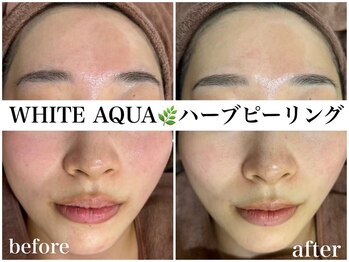 アワピール 天王寺店(AWA PEELL)/ハーブピーリング/ニキビケア