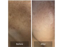 ポムポムボナー/「シミ」と同時にハリつや改善♪