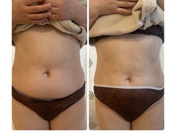 小顔アンドエイジングケア専門店 ビゼ(美sser)/REVIスカルプト12回