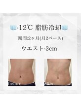 メディカルエステ 東銀座店/-12℃脂肪冷却 before/after