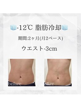 メディカルエステ 東銀座店/-12℃脂肪冷却 before/after