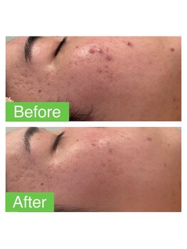 リヒト(LiHiTO)/ハーブピーリング1回の効果♪