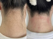 シロ(Shiro)/MIX脱毛うなじデザイン