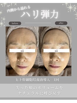 シイ(total skin beaute sii)/60代　ヒト幹細胞導入 1回
