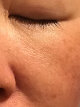 ローズノート(Rose Note)/リブセラ毛穴・赤みケア1