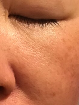 ローズノート(Rose Note)/リブセラ毛穴・赤みケア1