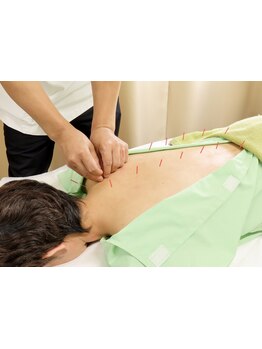 鍼灸施術を受けたい