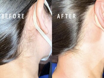 セレ(Cele)/うなじ脱毛♪