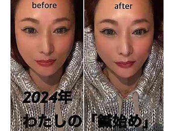 ルディア 堂島店(ledia)/大阪美容鍼歴16年 50歳代