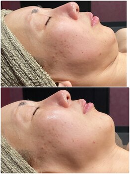 グロー(GLOW)/BBLフェイシャル