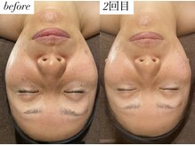 ディサイドロー(DECIDE L.A.W)/before after