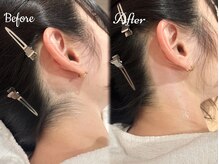 ピミル(PIMIL)/うなじ脱毛