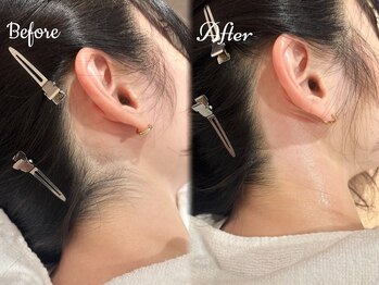 ピミル(PIMIL)/うなじ脱毛