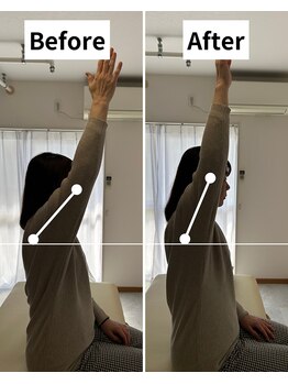 Root整体院【首・肩こり/腰痛/根本改善】/肩こりBefore/After