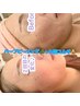 【肌管理】水光肌/LHAララピールピーリング×肌質改善×小顔コルギ60分¥15000